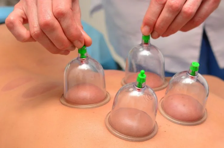 Cupping Therapy 2